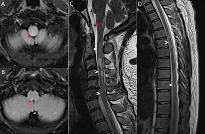 Case Report: Ofatumumab treatment in a patient with rituximab-intolerant refractory autoimmune GFAP astrocytopathy